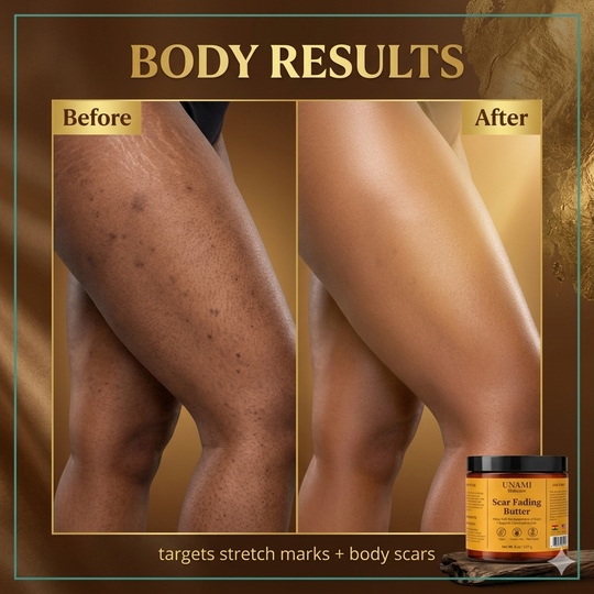 Scar Fading Body Butter | Stretch Mark & Dark Spot Treatment