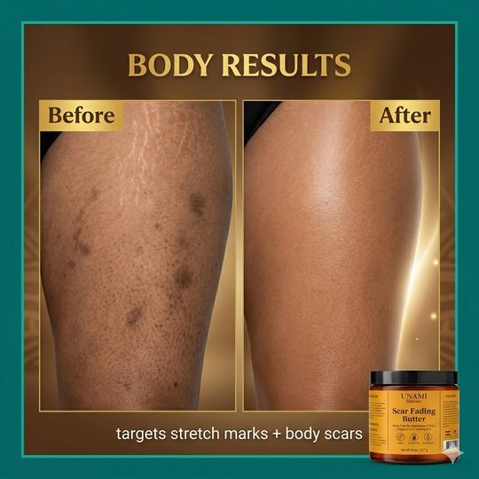 Scar Fading Body Butter | Stretch Mark & Dark Spot Treatment